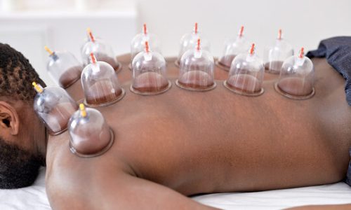 Acupuncture Herbal Center Cupping